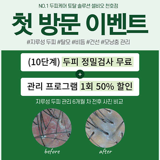 셀비오 천호점 톡톡 쿠폰 두피,탈모관리