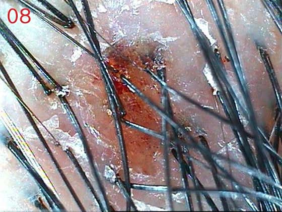 Hair loss story