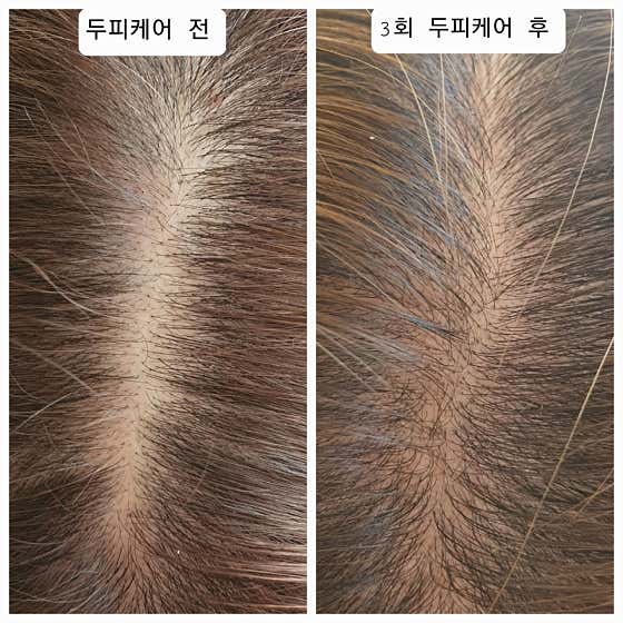 Gangneung Scalp Solution Healing Harbor