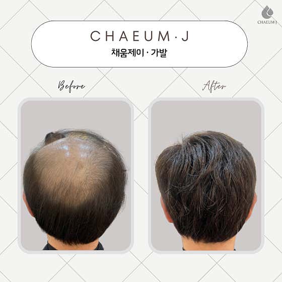 Chaeum J Wigs, Hair Growth Treatment, Scalp & Hair Loss Management