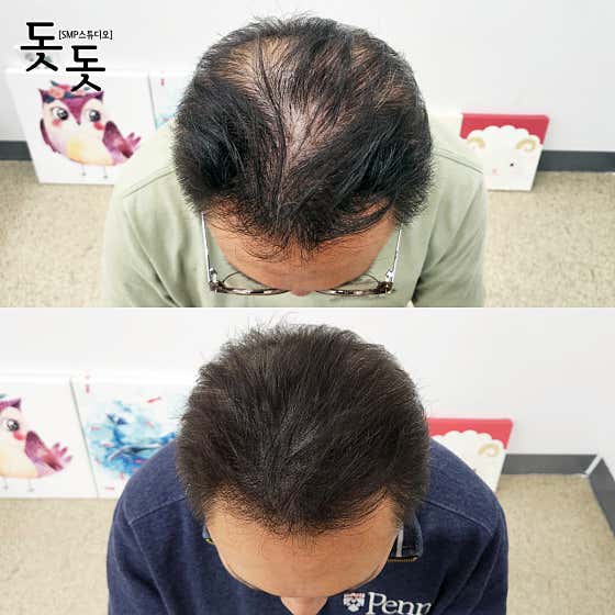 마지노스칼프