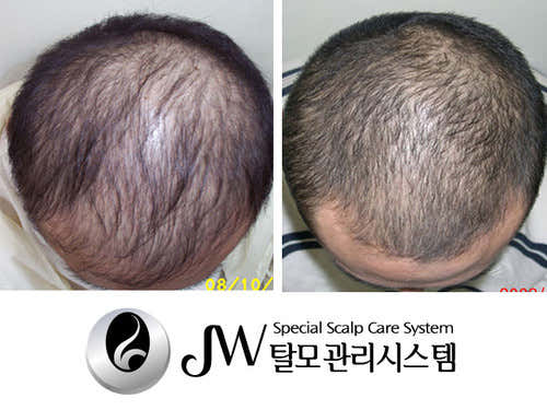 JW Hair Loss Management Center