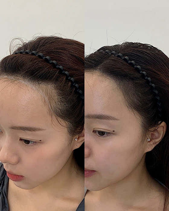 럼플