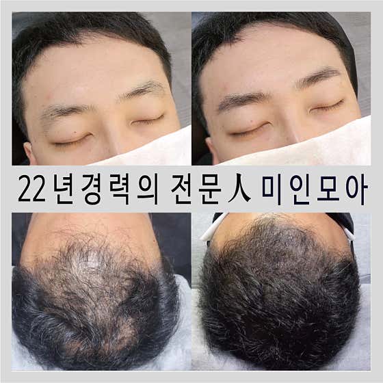 대전 눈썹두피문신 미인모아