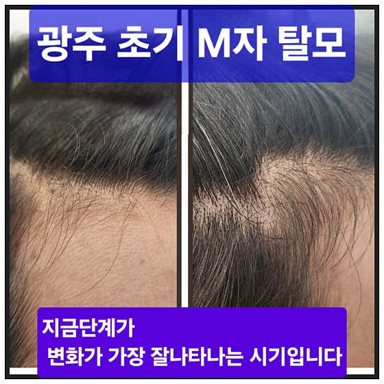 미르두피탈모 수완점