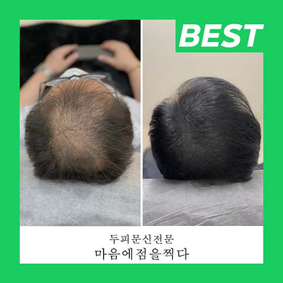 Gwangju Scalp Tattoo SMP Hair Loss
