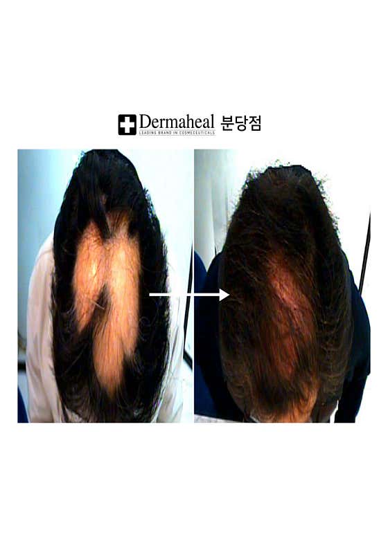 엠지에프두피탈모 전문센터 분당야탑점