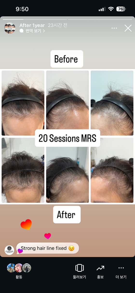 Standard Scalp