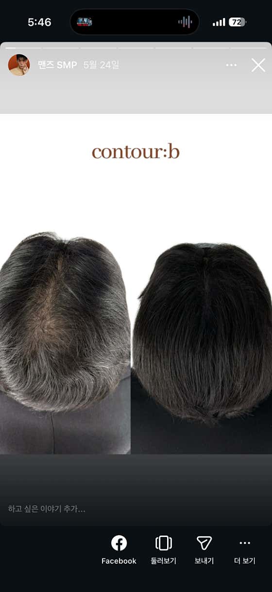 大田頭皮輪廓 B