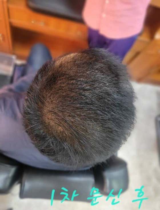 Full-filling scalp and hair loss management