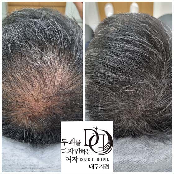 두피를 디자인하는 여자 대구점
