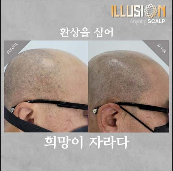 Illusion Scalp Anyang