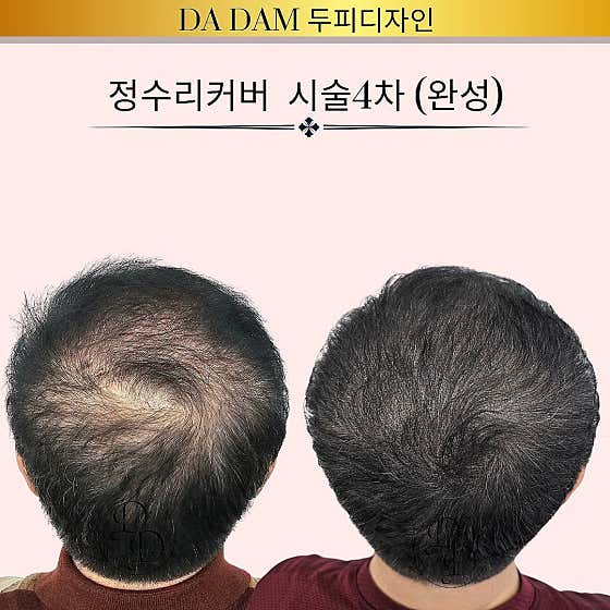 Dadam Scalp Design