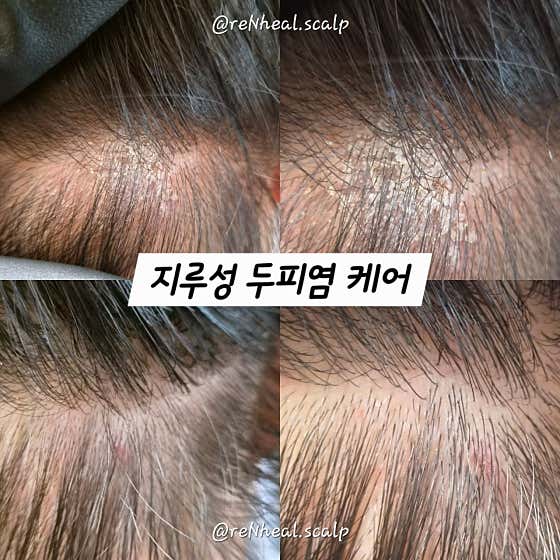 리앤힐 두피탈모