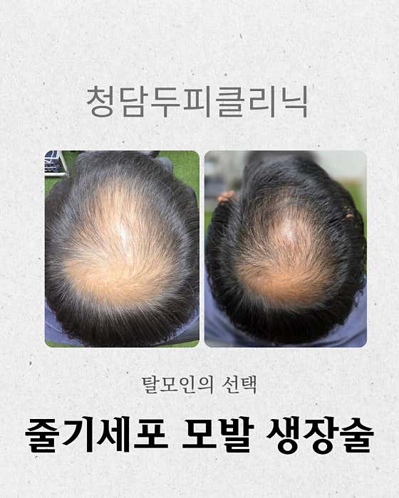 清潭頭皮診所