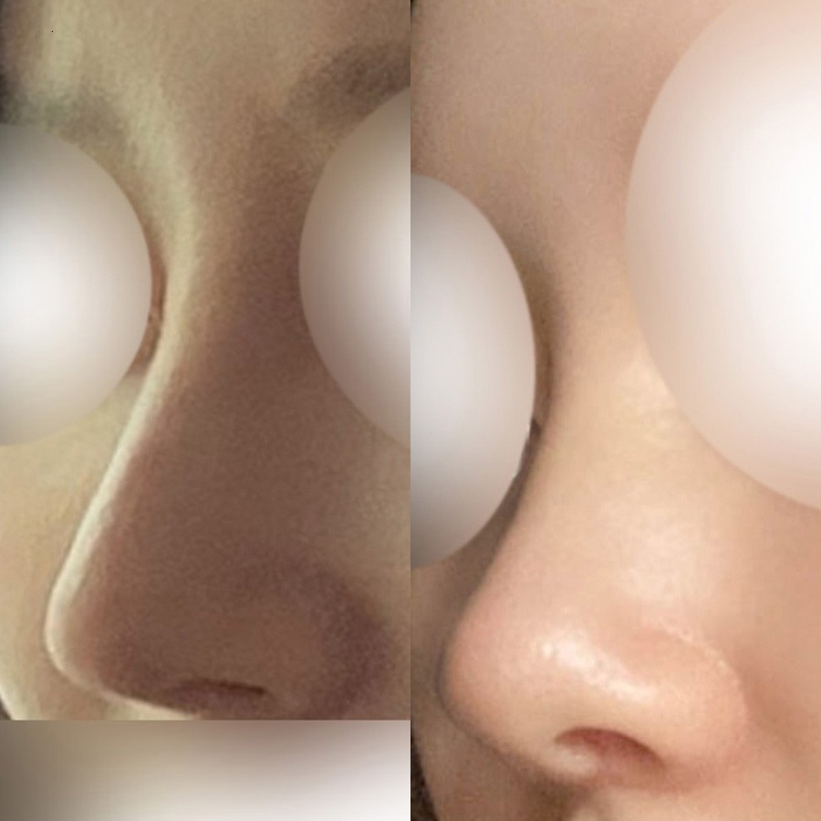 [Nose Revision Review] Dr. Choi Joong-hyuk of Apgujeong Seoul Plastic Surgery: The Reason He Successfully Revisionized a Patient's Nose from a Pointed Pinocchio Tip to the Desired Shin Se-kyung Line